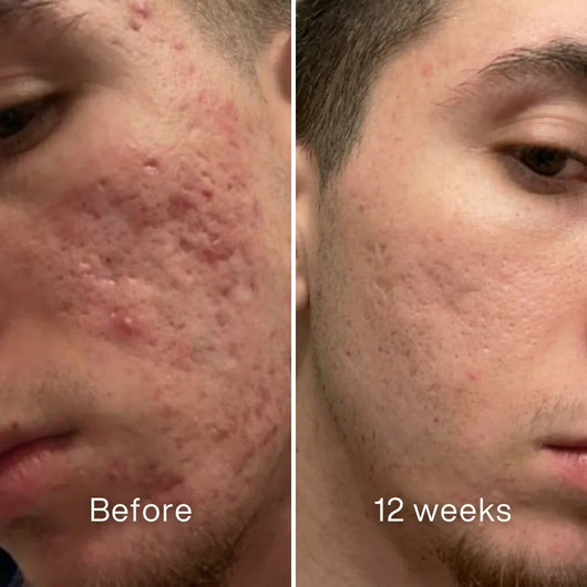 Acne Scar Invisible Repair Barrier™