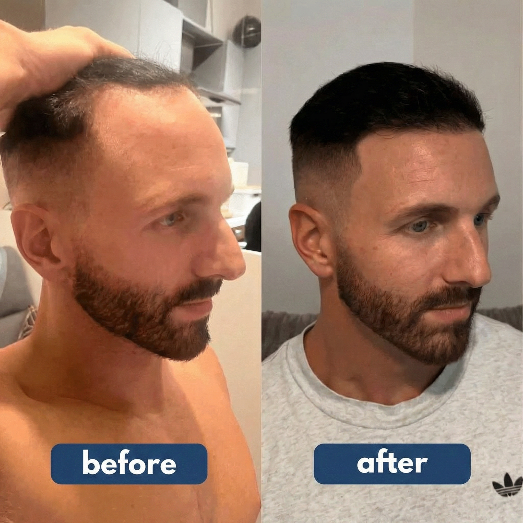 SEREVIA - HAIR GROWTH SERUM