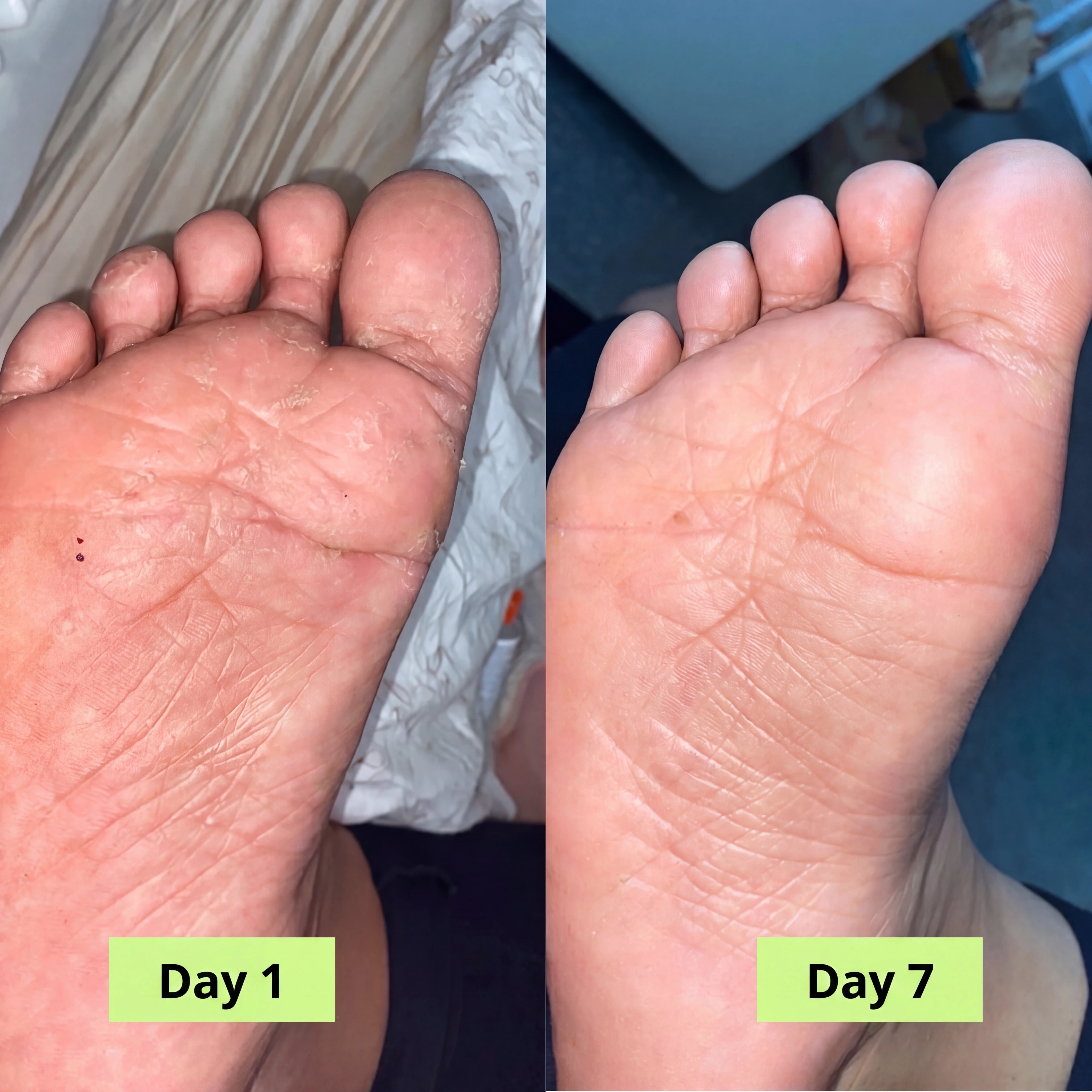 Serevia® Purifying Antifungal Soap